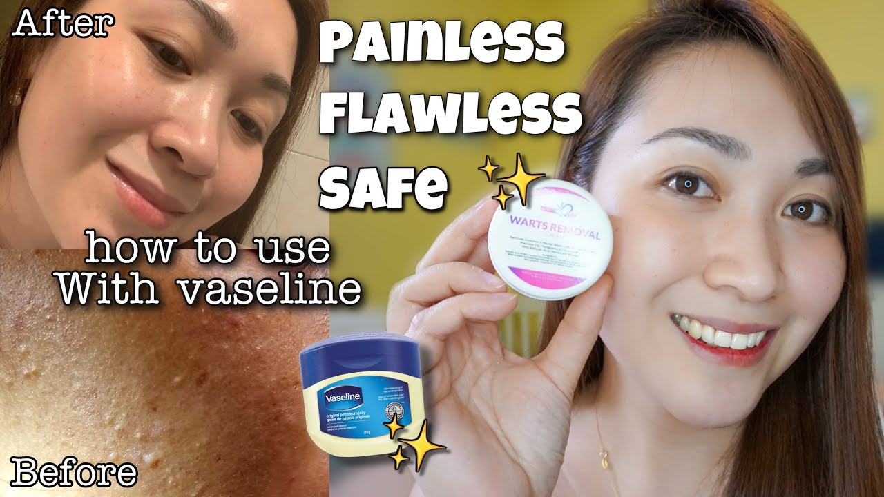 MONTH TRYING FACIAL WARTS CREAM REMOVAL FROM Skin + GUIDE FOR EFFECTIVE ayaesguerr - YouTube