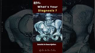 She Carried Her Unborn Child For 61 Years. A Rare Case Of A Stone Baby