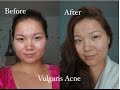 Үрэвсэлтэй батганаас салах аргууд | How to defeat Vulgaris Acne