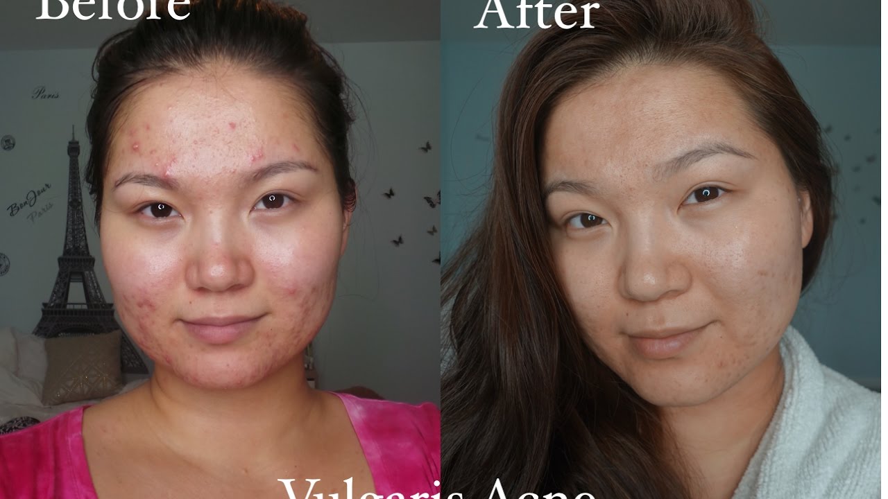 Үрэвсэлтэй батганаас салах аргууд | How to defeat Vulgaris Acne