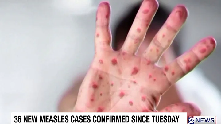 Texas measles cases rise to 541 as outbreak spreads