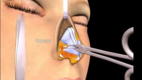 Mô phỏng 3D Nâng Mũi Cấu Trúc | Tìm Hiểu Quy Trình Tại Bệnh Viện Việt Mỹ Với Bác sĩ Chiêm Quốc Thái