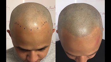 Learn Scalp Micropigmentation at FULL Micropigmentation in Las Vegas, NV