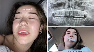 Getting ALL my Wisdom teeth Removed!