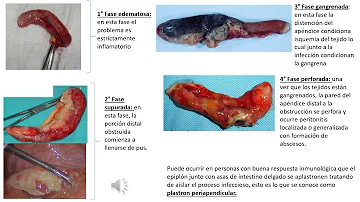 ¿Cuáles son las 4 fases de la apendicitis?