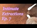 Intimate Extractions Ep. 7 | It’s a Big One Lol 😂