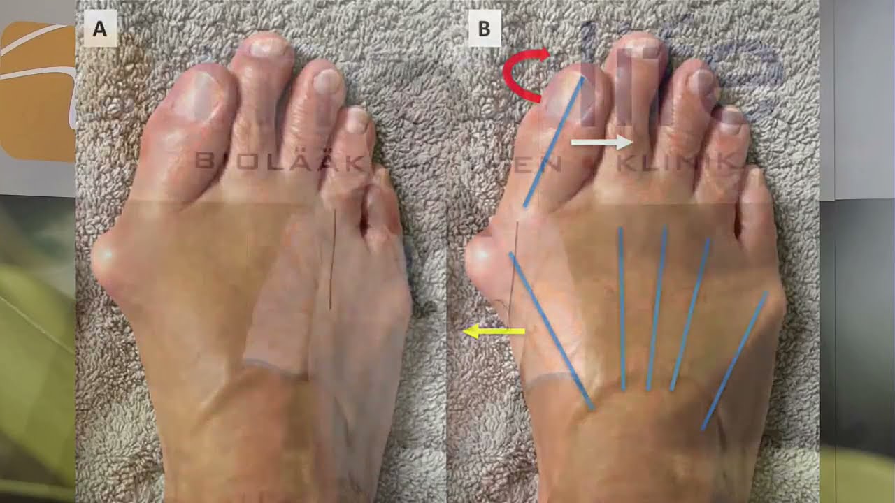 8.9.2021 Vaivasenluu, jalan kipeä vaiva, syntymekanismit ja hoito