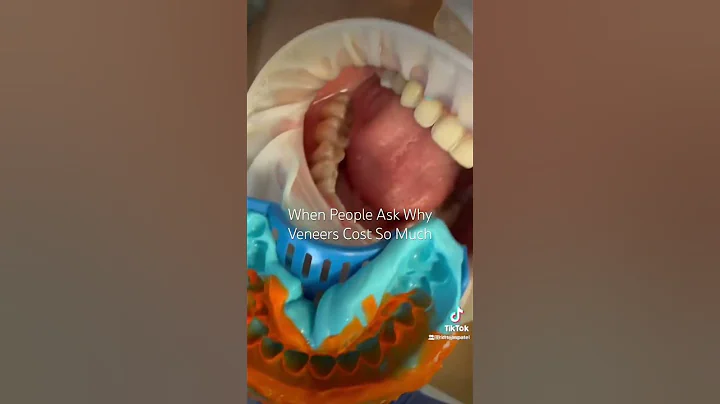 Porcelain Veneers Cost. #veneers #cosmeticdentist #costofveneers #shorts #veneerprocess