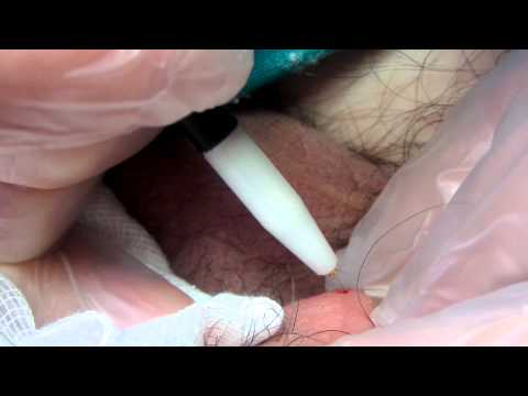 Fordyce Spots Removal with Electrolysis