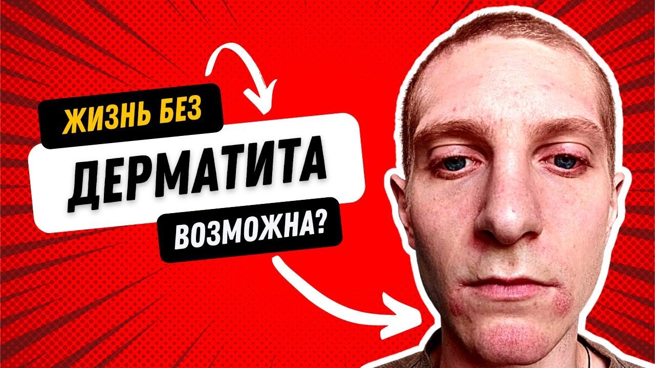 Пятна на лице прошли без тридерма (лечение себорейного дерматита) Отзыв ...