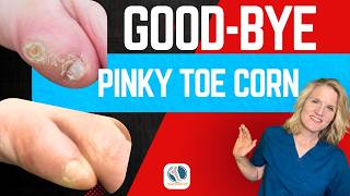 Your Pinky Toe Corn Doesn't Have to Hurt This Bad