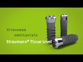 Установка имплантата: Straumann® Tissue Level