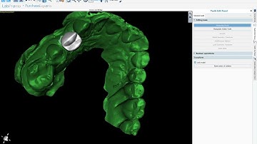 BSPV4.11: Designing Crowns for Titanium Base Abutments in BlueSkyPlan. Free!