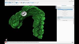 BSPV4.11: Designing Crowns for Titanium Base Abutments in BlueSkyPlan. Free!