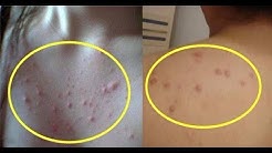 Bahaya Sering Muncul Jerawat di Punggung - Durasi: 5.01. Bahaya Sering Muncul Jerawat di Punggung - Durasi: 5.01.