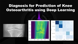 Diagnosis for prediction of knee osteoarthritis using deep learning | X-Rays Image Classification