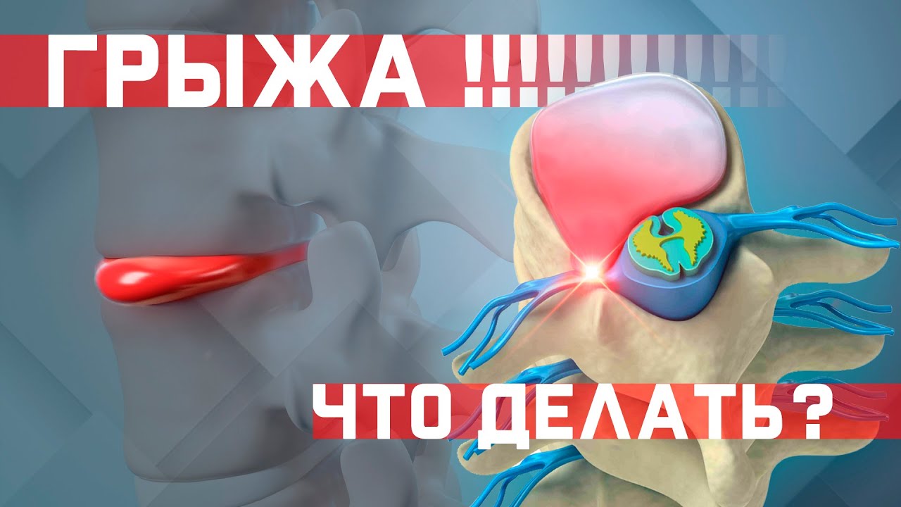 Как лечить межпозвоночную грыжу? Как жить с грыжей? Что с ней делать?
