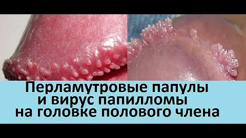 Перламутровые папулы и вирус папилломы на головке полового члена. Из практики дерматовенеролога.