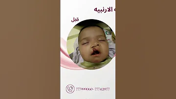 قصة نجاح الشفة الأرنبية لطفل صغير شفه ارنبيه قصه نجاح تجميل د الشرجبي مركز تجميل صنعاء 