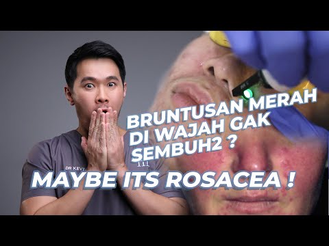 Video: Cara Mengobati Ocular Rosacea: 14 Langkah (dengan Gambar)