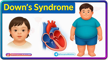 Down Syndrome (Trisomy 21) Animation | Causes, Features & Clinical Insights for NEET PG & USMLE