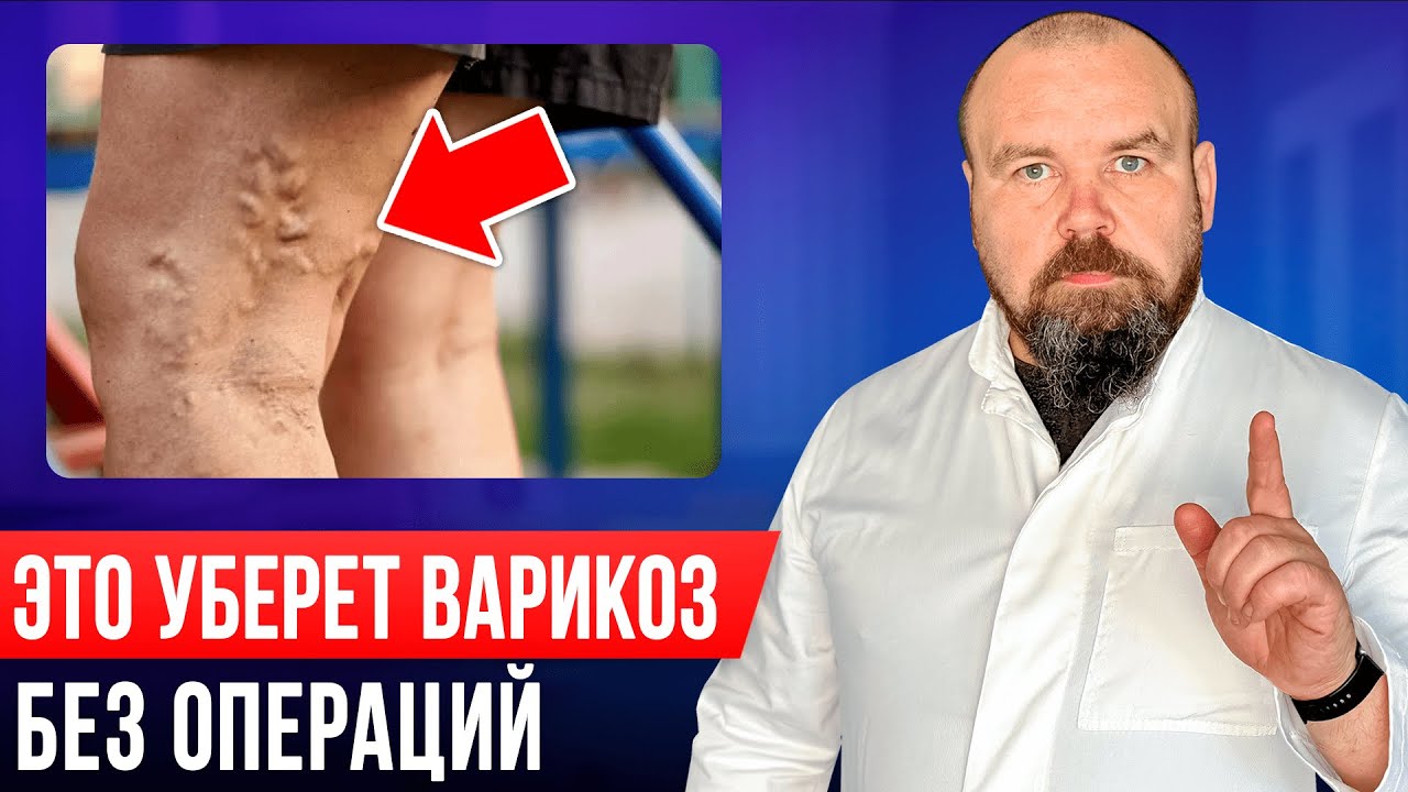 Лечение варикоза БЕЗ ОПЕРАЦИЙ и ЛЕКАРСТВ! Это проще чем вы думаете ...