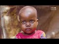 Luul’s recovery from severe malnutrition in Somalia | UNICEF