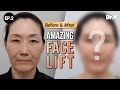 Plastic surgery review facelift infrabrow blepharoplasty  vlif plastic surgery korea