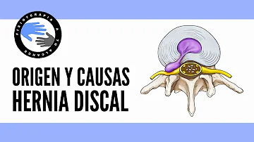 ¿Por qué se producen las hernias discales?