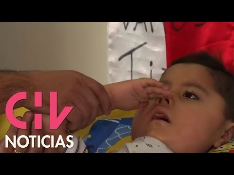 Video: Hipotrofia En Niños