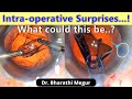 Intraoperative surprise during routine phacoemulsification  the hidden thief  dr bharathi megur