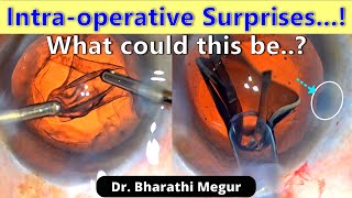 Intra-Operative Surprise During Routine Phacoemulsification The Hidden Thief - Dr Bharathi Megur