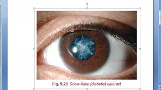 cataract diabetes mellitus 2-kezelés