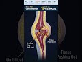 नाभी के पास उभार? ये अम्बिलिकल हर्निया हो सकता है | Umbilical Hernia Explained #shorts