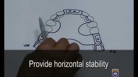 Designing an Upper Metal Partial Denture Kennedy Class III