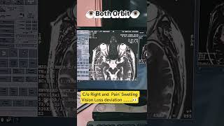 MRI both Orbit 6th nerve and Fiesta Image 👀 #anatomy #orbit #medicalimaging #youtube