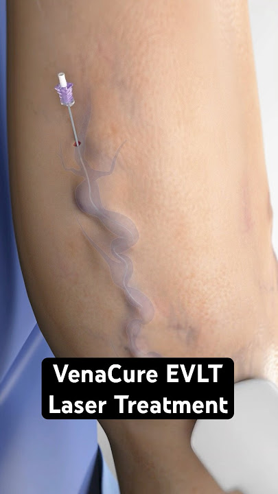 Using a laser to zap varicose veins (3D Animation)