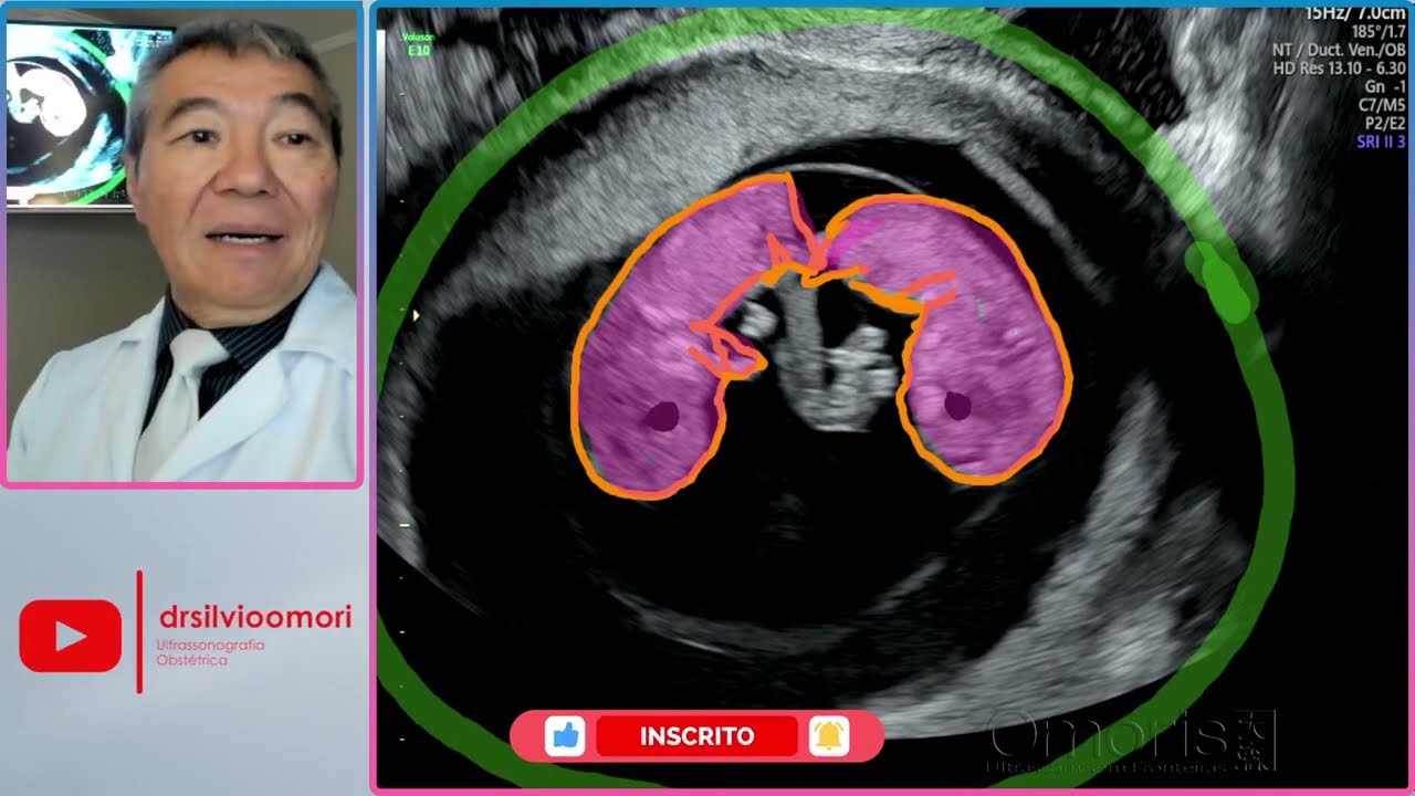 Knowing a mono-mono twin pregnancy!