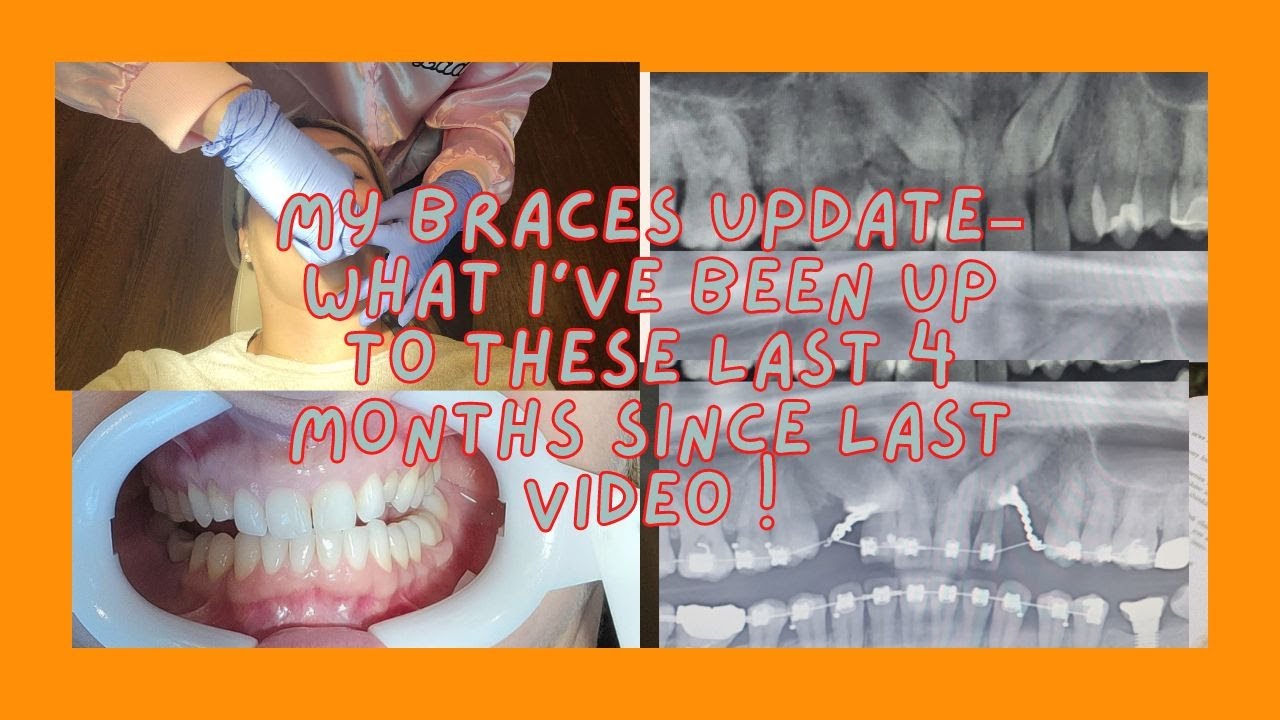 MY BRACES UPDATE JulyOctober 2022 WHAT HAVE WE BEEN UP TO THESE LAST