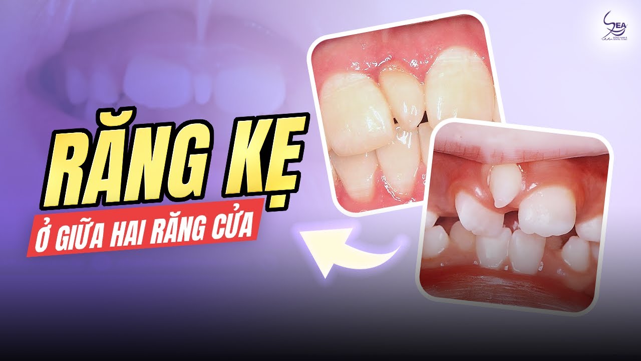 MẤT THẨM MỸ KHI RĂNG KẸ MỌC GIỮA HAI RĂNG CỬA. PHẢI XỬ LÝ NHƯ THẾ NÀO ...