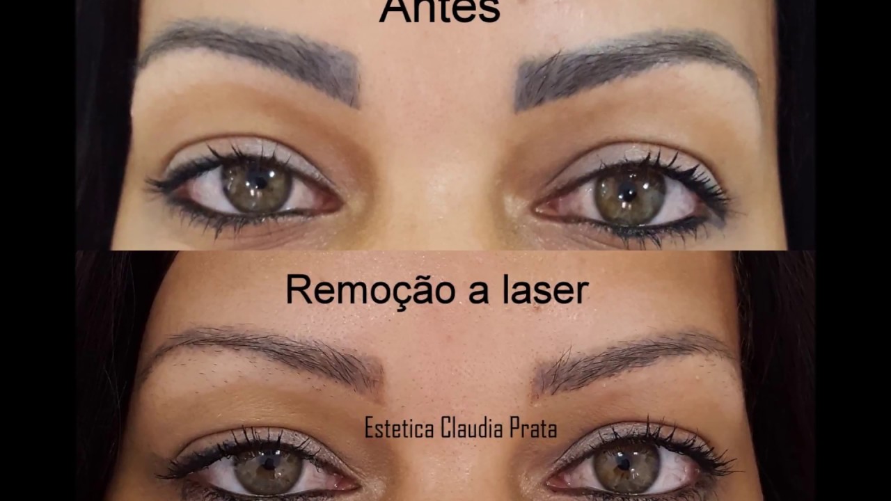 remoção a laser despigmentação de sobrancelha - YouTube