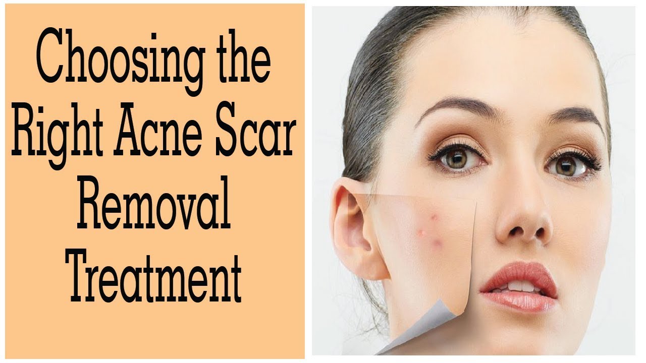 Treatment Options To Remove Acne Scars The Esthetic Clinics, India