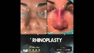 Rhinoplasty with dr. mostafa el okazi