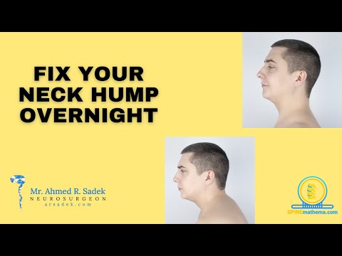 Fix Your Neck Hump Overnight Science Backed Hacks Mr Ahmed Ramadan Sadek Neurosurgeon Neckpain