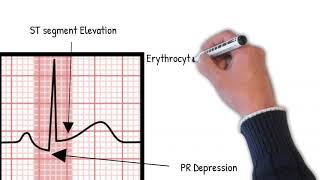 ¿Cuándo se produce el síndrome de Dressler? - Síntomas, pronóstico, tratamiento