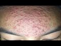 Acne Treament Under The Skin #052