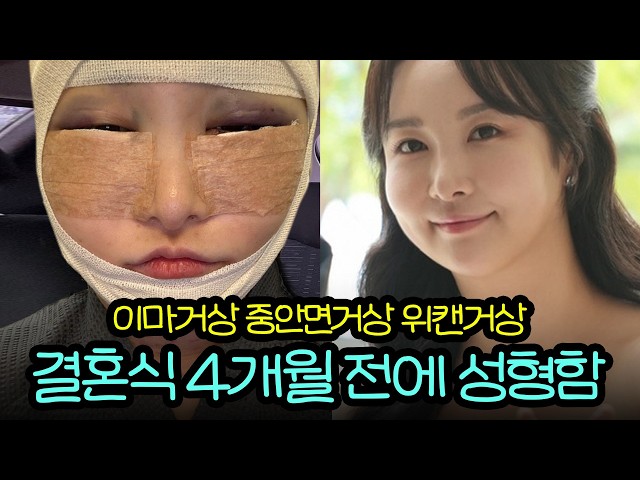 결혼 4개월 전 남편 몰래 수술ㅋㅋ💛 [이마거상 + 중안면거상 + 위캔거상 + 아그네스 수술 당일 vlog]🔥