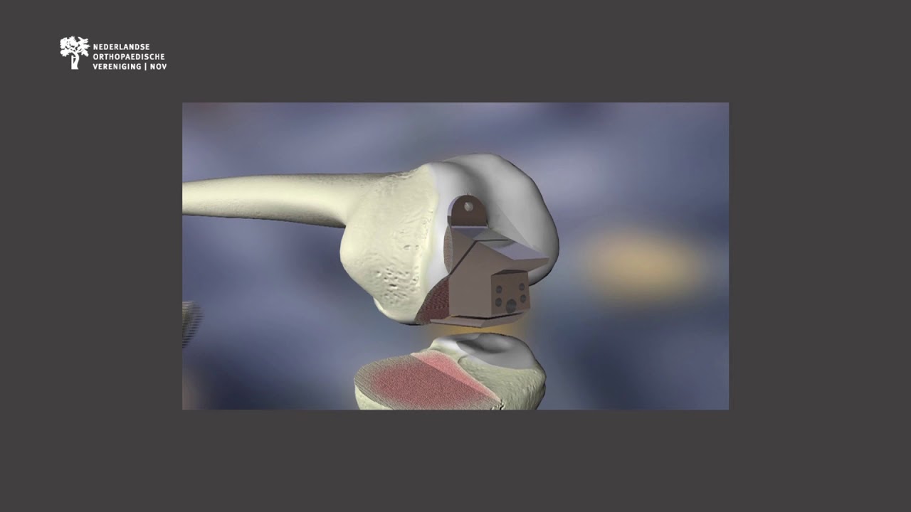 Animatie plaatsen halve knieprothese