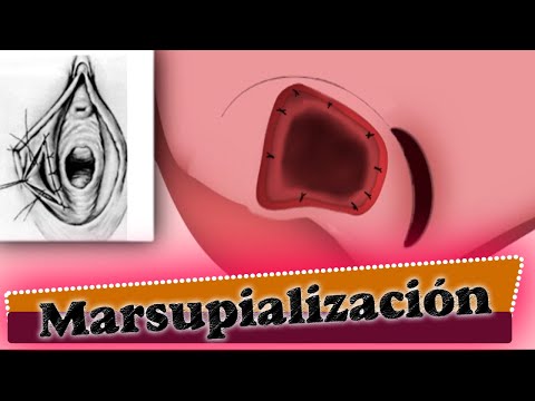 Vídeo: Marsupialización: Procedimiento, Recuperación Y Más