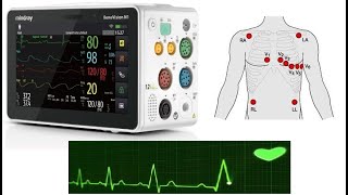 Mindray BeneVision N series - how to make a 12L ECG (and send it to Muse)